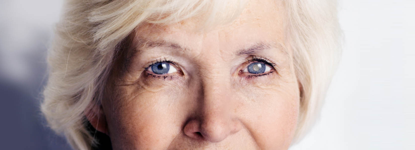 Cataract Surgery in Orlando